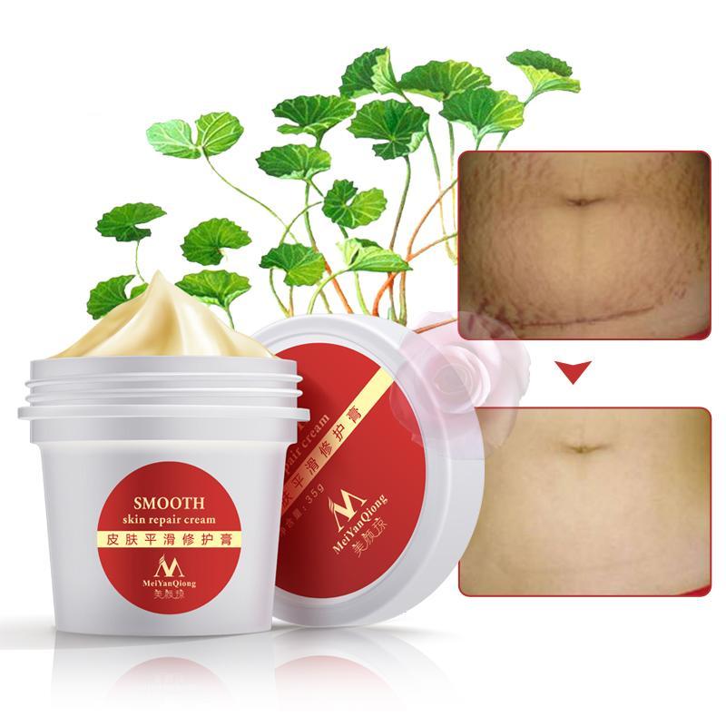 Postpartum Stretch Marks Remover Cream