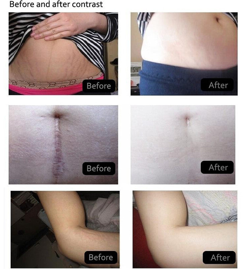 Postpartum Stretch Marks Remover Cream