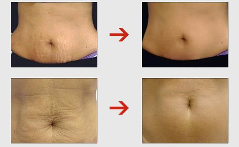 Postpartum Stretch Marks Remover Cream