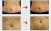 Image of Postpartum Stretch Marks Remover Cream